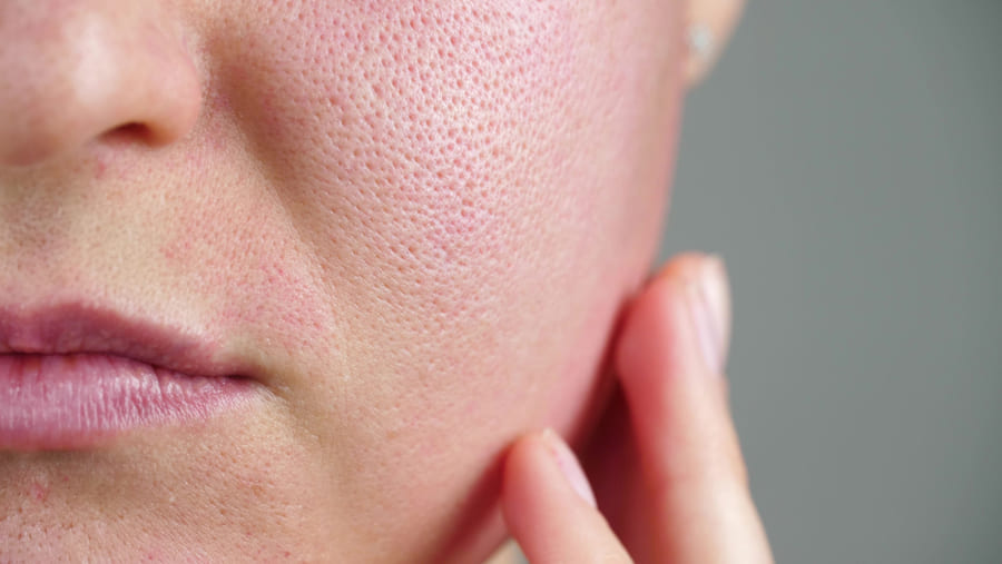 Pele Oleosa, Acne e Poros Dilatados